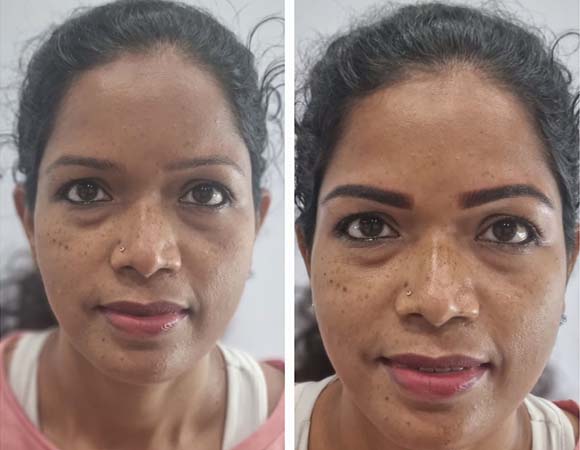 FacialTreatment in Kilpauk