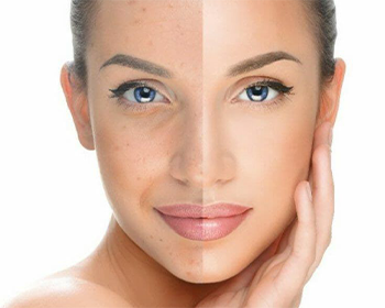 Keratin & Botox Treatment Kilpauk, Chennai